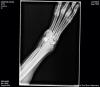 Jay Xray Broken Foot